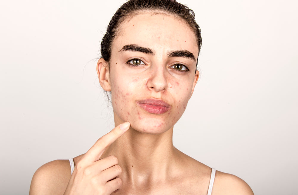 Acne Scarring Laser Treatment