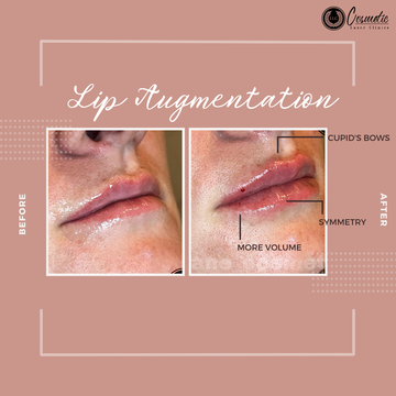 Lip Augmentation LLC Cosmetic Laser Clinics