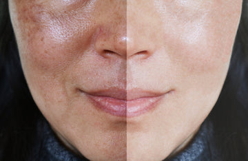 Benefits Laser Skin Resurfacing
