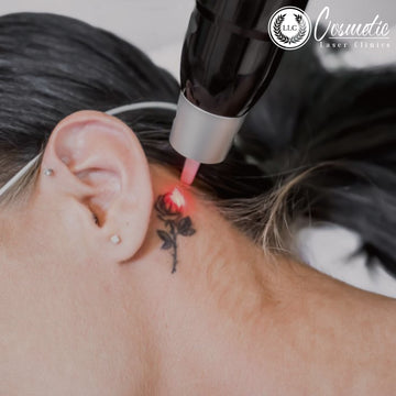 Say Goodbye to Ink Regrets: Why Laser Tattoo Removal Is Your Best Bet