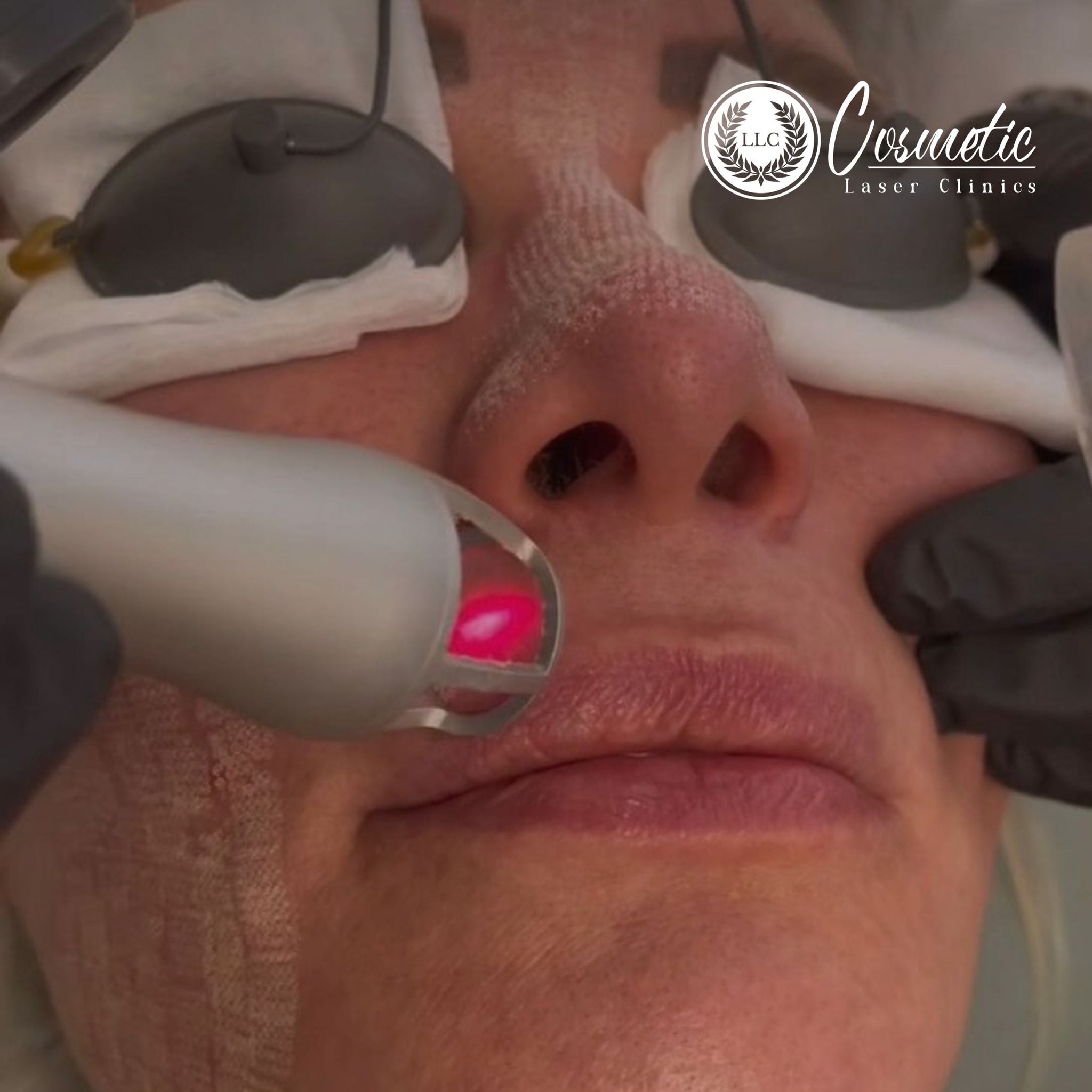 Brisbane's Best Laser Skin Resurfacing for a Fresh Look
