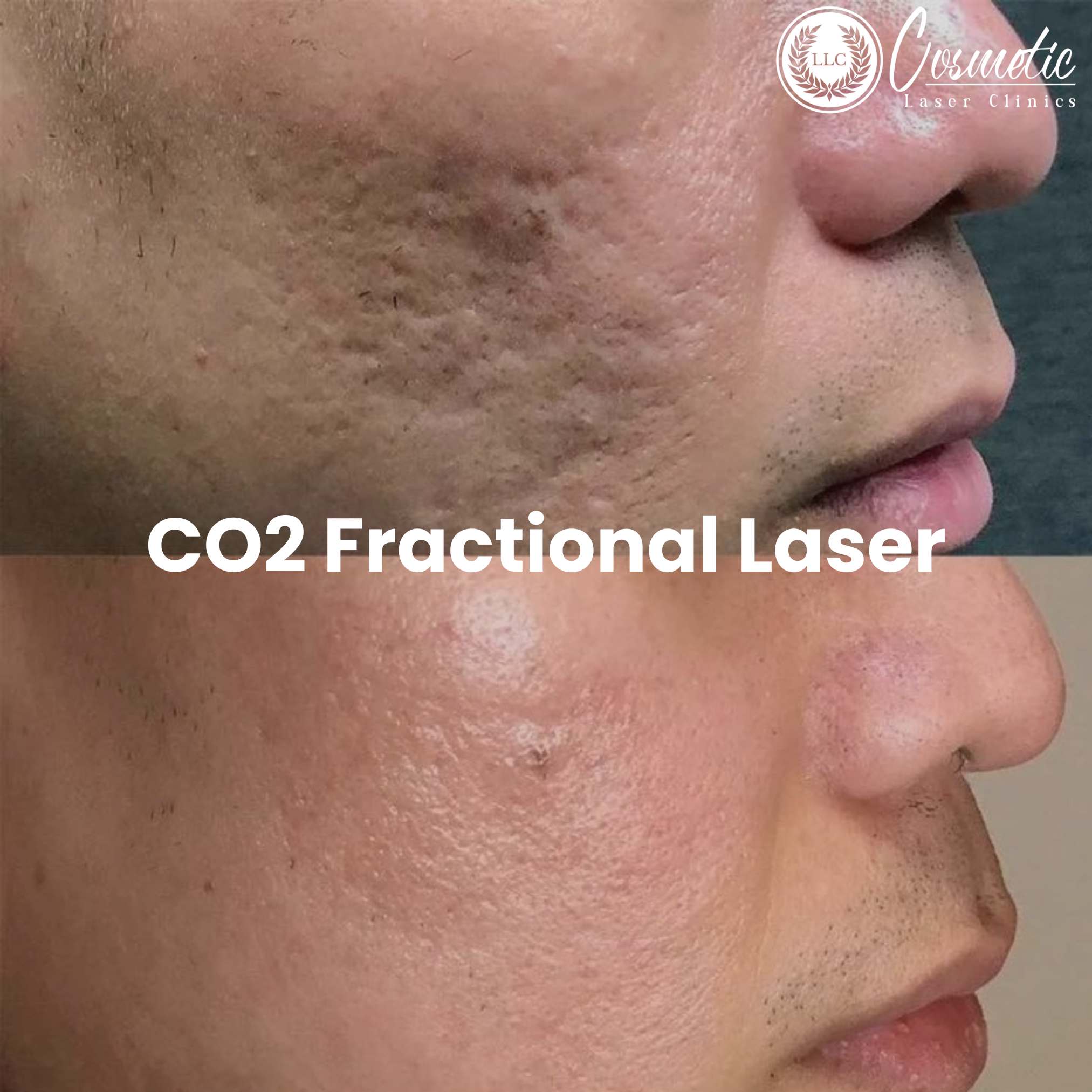 How to Achieve the Perfect Skin with Fractional CO2 Laser