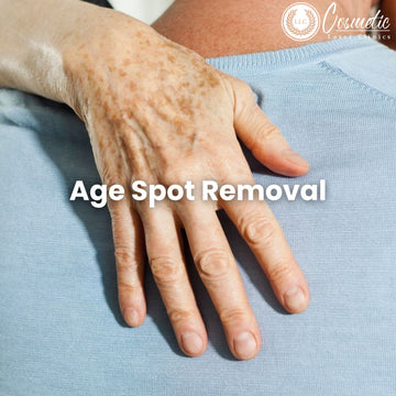 Age Spot Removal Clinic Near Me: Why You Should Consider Getting Rid of Age Spots