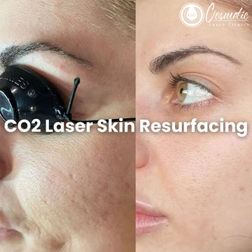 How to Achieve Radiant Skin with CO2 Laser Skin Resurfacing