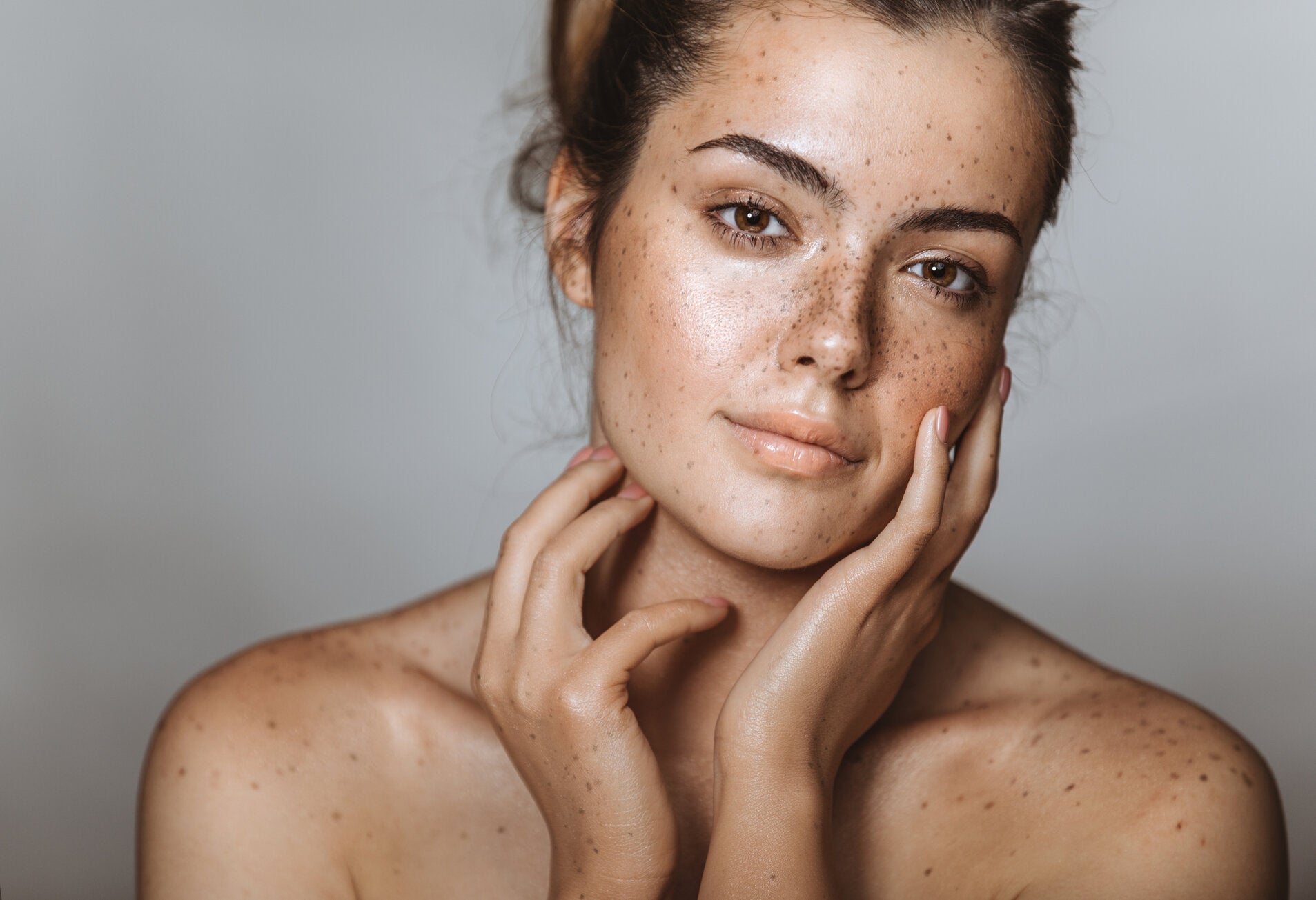 Freckle-Free Forever: Explore the Latest Innovations in Removal Techniques