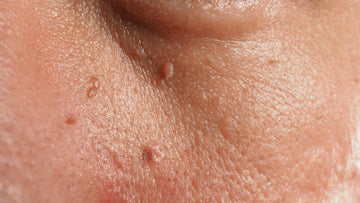Guide to Effective Skin Tag Removal