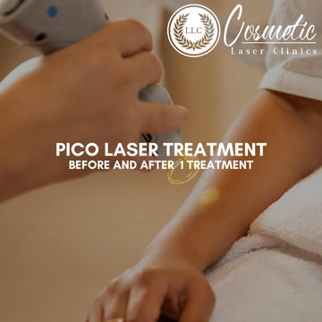 Before and After Pico Laser: Stunning Results from Just One Treatment