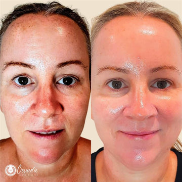 Bye Wrinkles! CO2 Laser Resurfacing for Insta-Glow Skin!