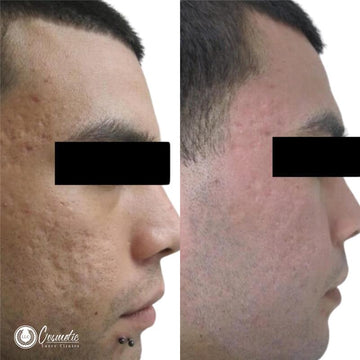 Fractional CO2 Laser: What to Expect & Why You’ll Love It