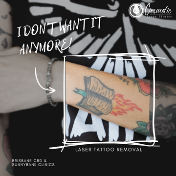 Laser Tattoo Removal