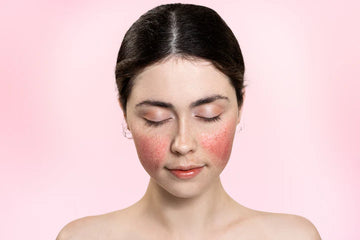 How Laser Treatments Can Help With Rosacea?