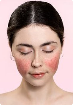 Rosacea Treatments