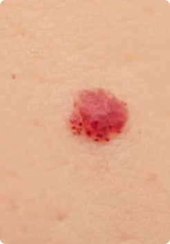 Cherry Angioma Removal