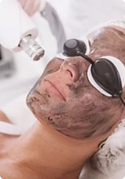 Carbon Laser Facial