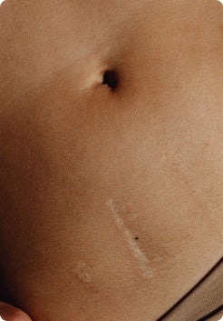 Burn Scar Removal