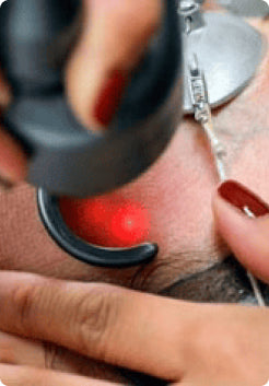 CO2 Fractional Laser Resurfacing Treatment