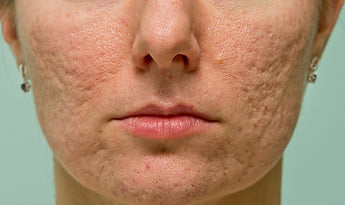 Acne Scarring