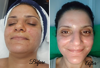 Skin Resurfacing Treatments