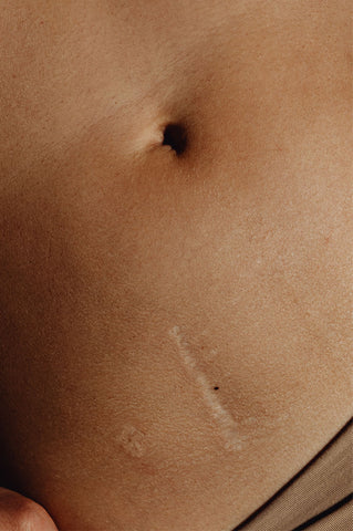 Burn Scar Removal