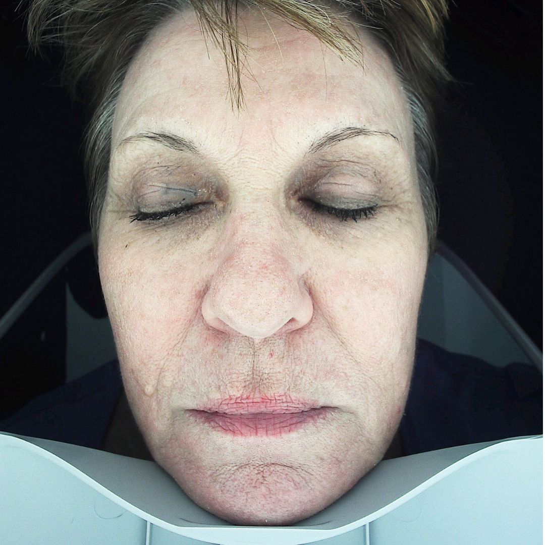 Anti-ageing + Pigment Treatment - After