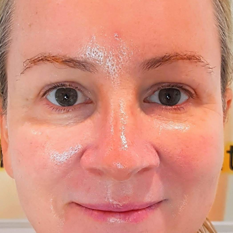 After CO2 Skin Resurfacing