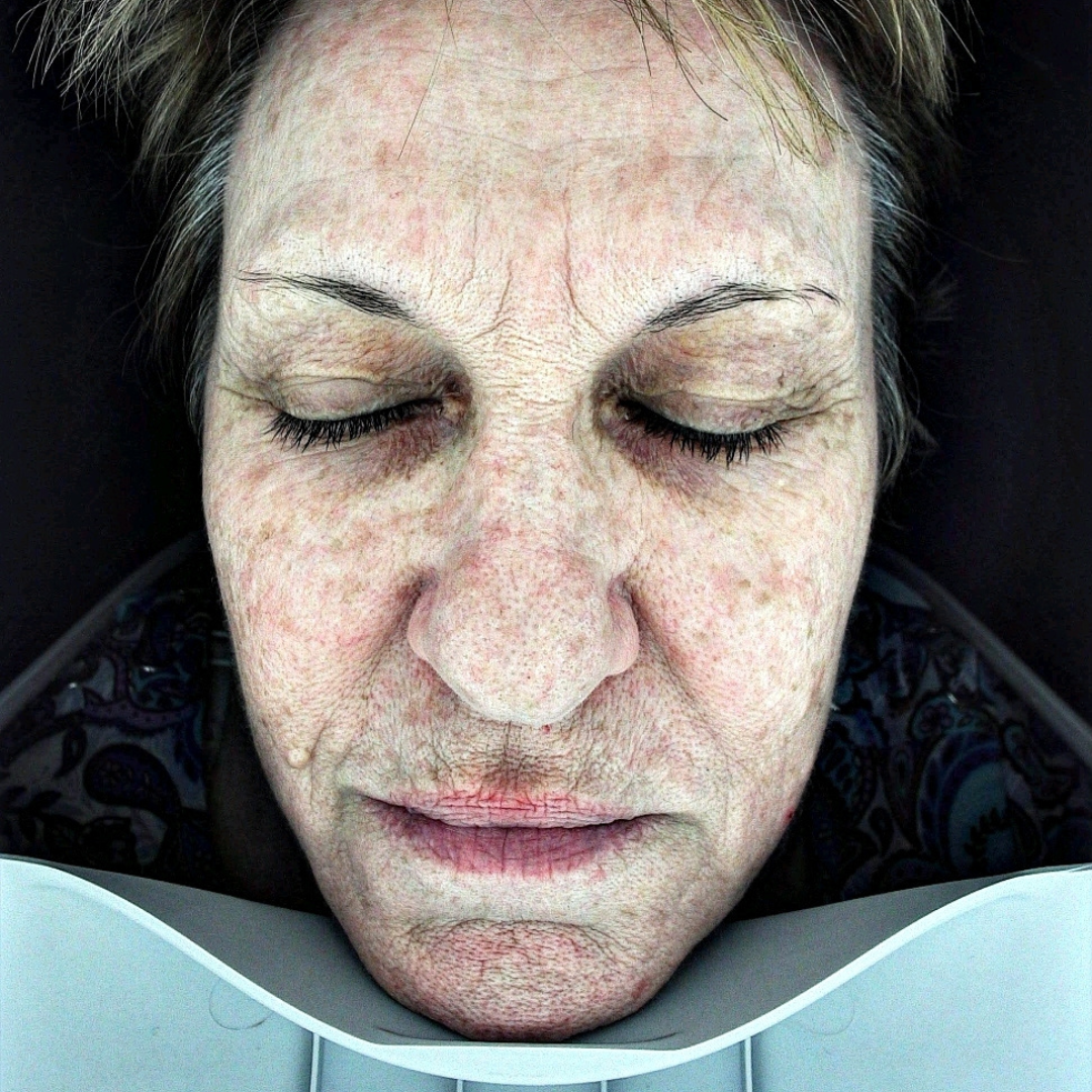 Anti-ageing + Pigment Treatment - Before