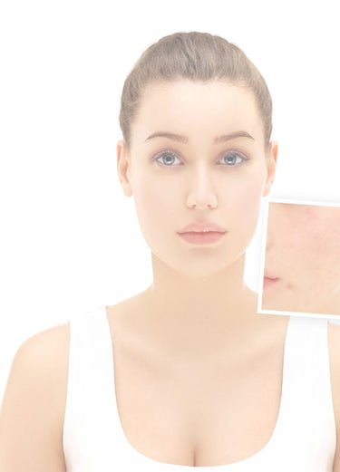 acne scarring treatment