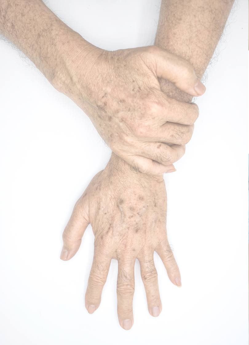 age spot removal brisbane