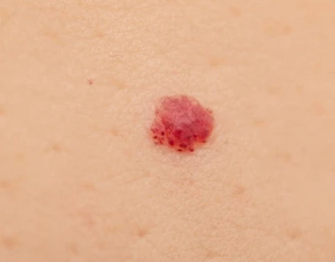 Cherry Angioma & Red Spots Removal Brisbane LLC Cosmetic