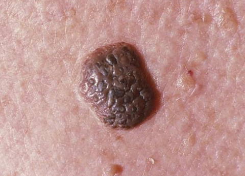 Seborrheic Keratosis Removal