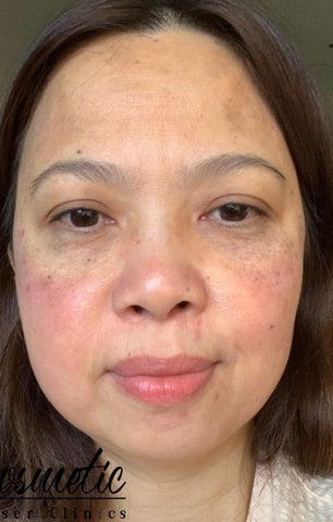 After Melasma CO2 Treatment + HIFU Skin Tightening