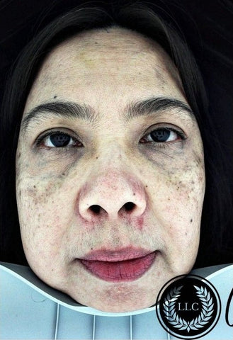 Before Melasma CO2 Treatment + HIFU Skin Tightening