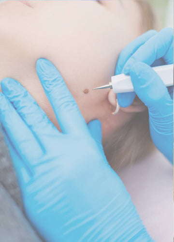 skin tag removal treatment