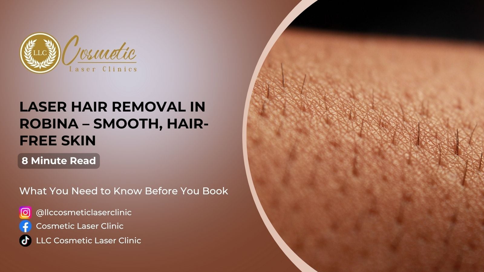 Laser Hair Removal in Robina – Smooth, Hair-Free Skin