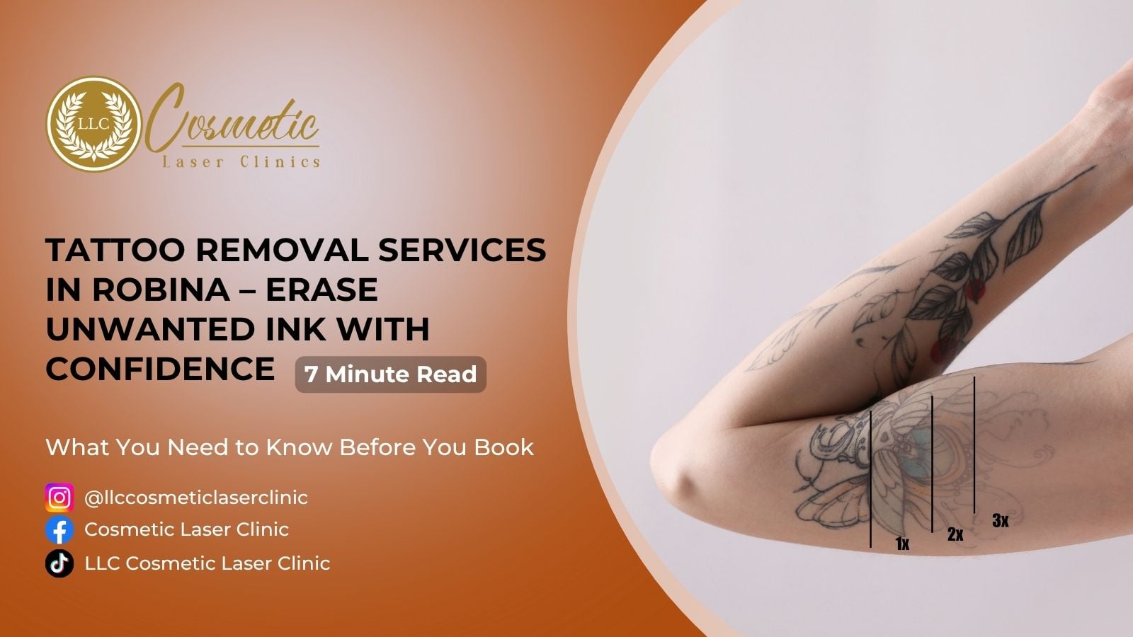 Tattoo Removal Services in Robina – Erase Unwanted Ink with Confidence