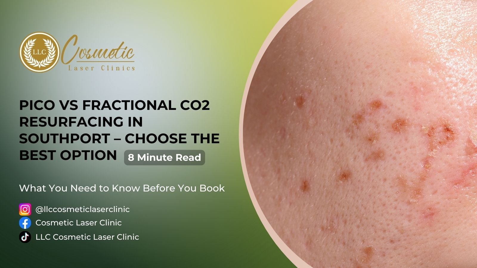 Pico Laser; pico laser near me; Fractional CO2 laser; CO2 laser skin resurfacing; skin resurfacing lasers