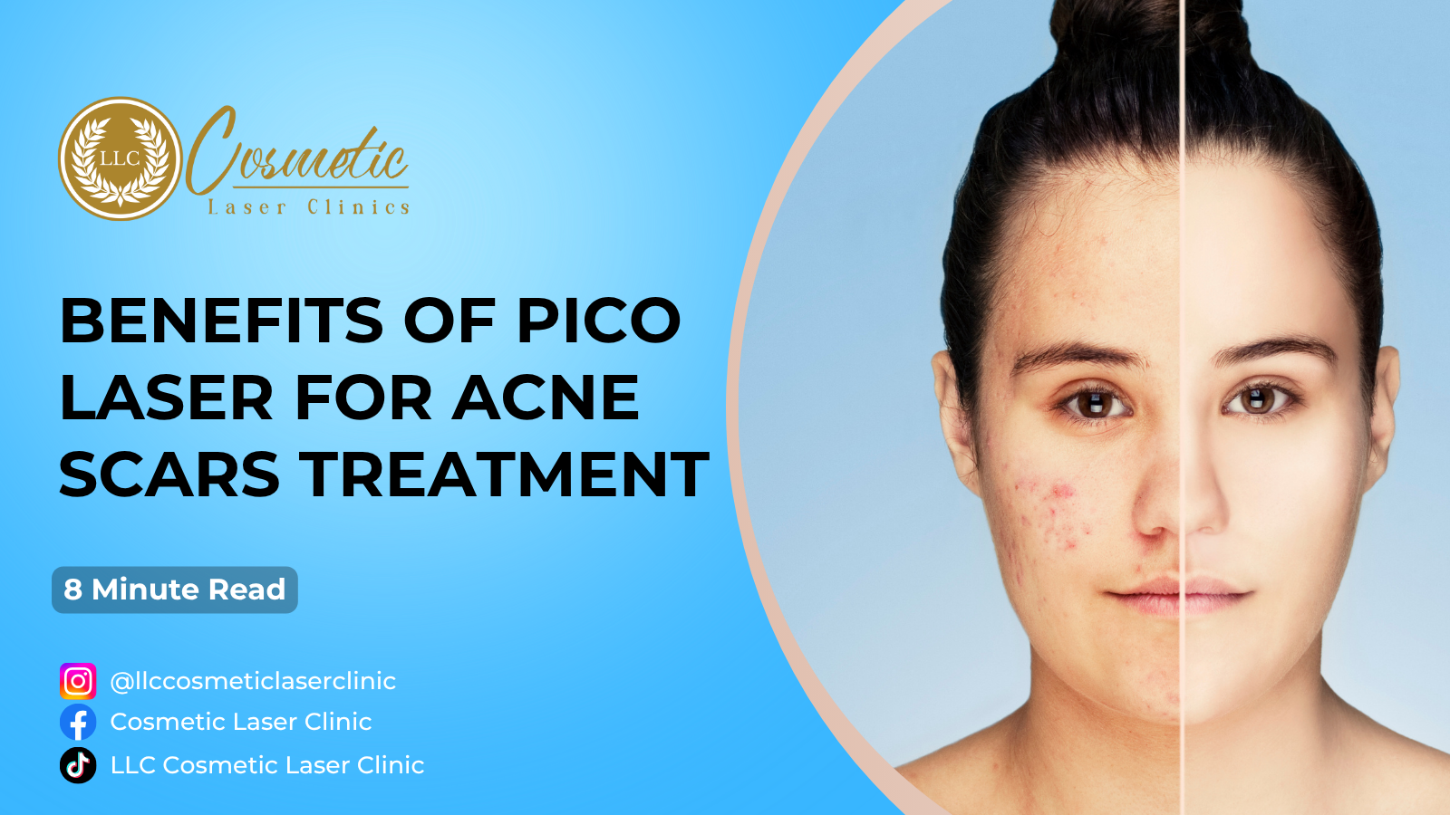 Benefits of Pico Laser for Acne Scars Treatment