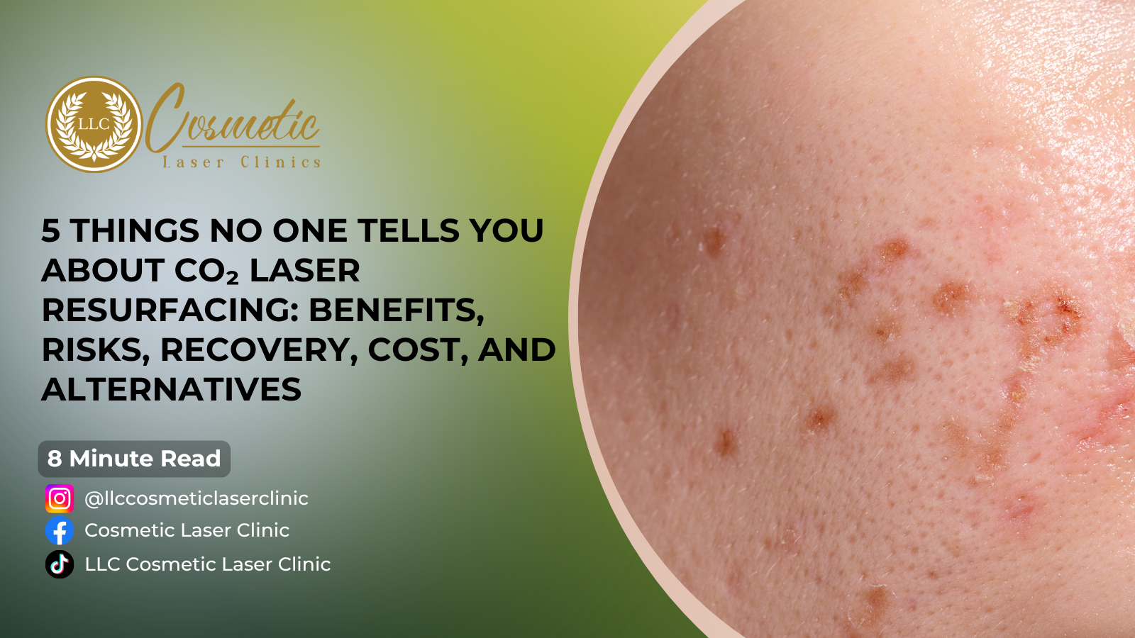 5 Things No One Tells You About CO₂ Laser Resurfacing: Benefits, Risks, Recovery, Cost, and Alternatives - Brisbane, Sunnybank, Southport, Robina