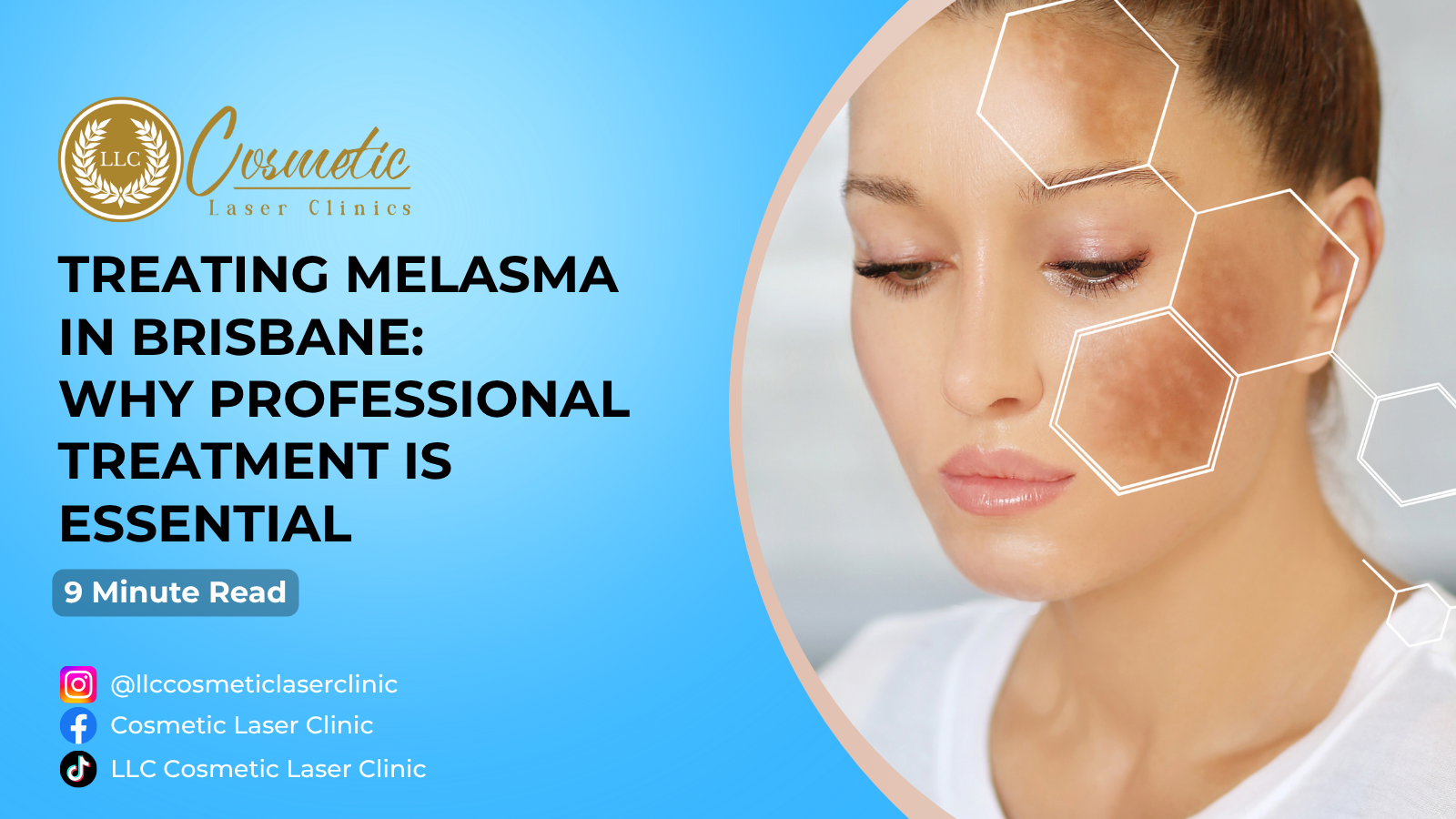 Treating Melasma in Brisbane: Why Professional Treatment Is Essential