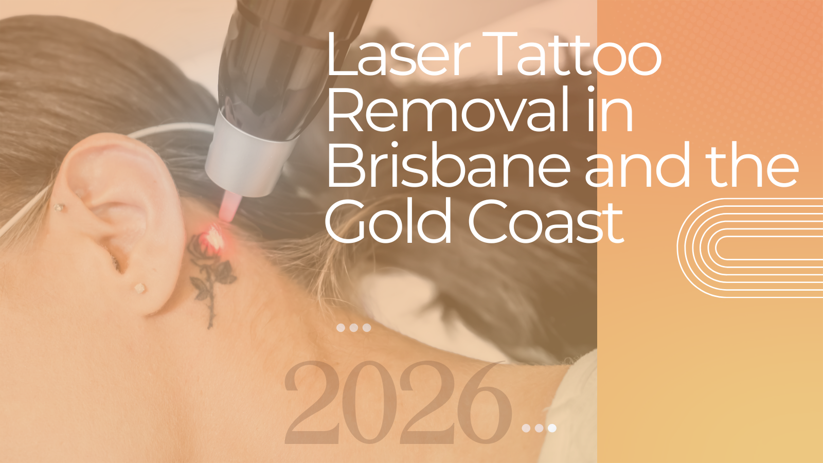Laser tattoo removal at LLC Cosmetic Laser Clinics in Brisbane