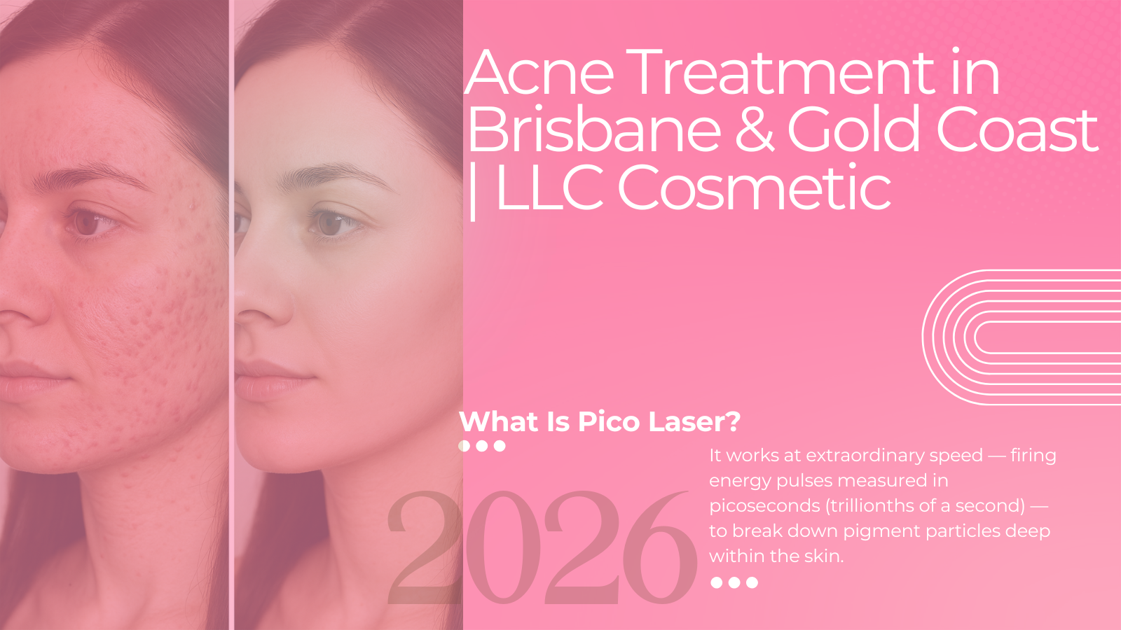 Acne treatment consultation at LLC Cosmetic Laser Clinics in Brisbane and Gold Coast